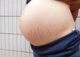 孕期如何预防妊娠纹？