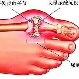 痛风怎么形成的？如何用活力霜调理现在就教你！